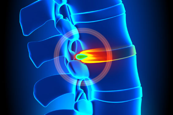 Herniated Disc Illustration